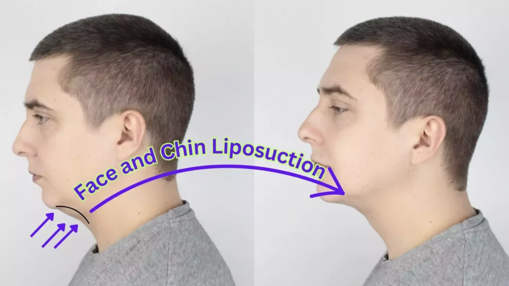 Face and Chin Liposuction Sculpting Your Facial Contours